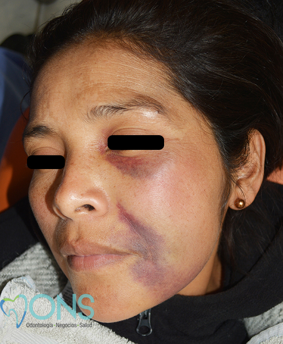 Hematoma post anestesia lesión del plexo venoso - 01