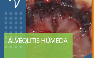 C07 ALVEOLITIS HÚMEDA