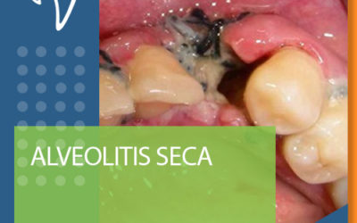 C08 ALVEOLITIS SECA