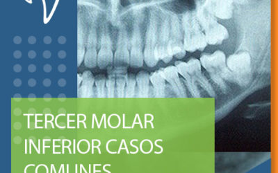 H02 TERCER MOLAR INFERIOR CASOS COMUNES