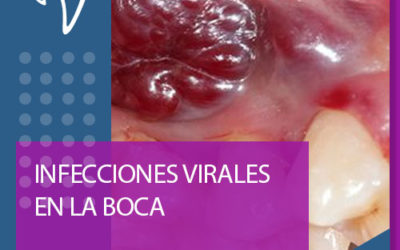 G03 INFECCIONES VIRALES EN LA BOCA